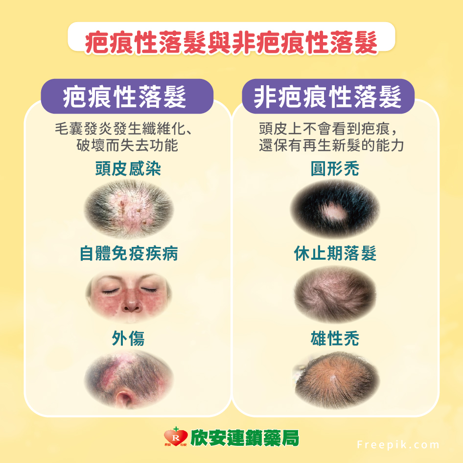 proimages/shinanhealth/20241125落髮/頭髮掉不停怎麼辦-05.jpg proimages/shinanhealth/20241125落髮/頭髮掉不停怎麼辦-05.jpg